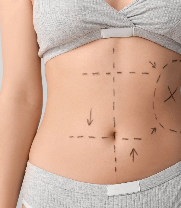 Nicht-chirurgische Fettentfernungsmethoden: Alternativen zur Liposuktion
