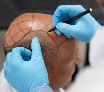 Pflege nach einer Haartransplantation: Tipps für die richtige Heilung