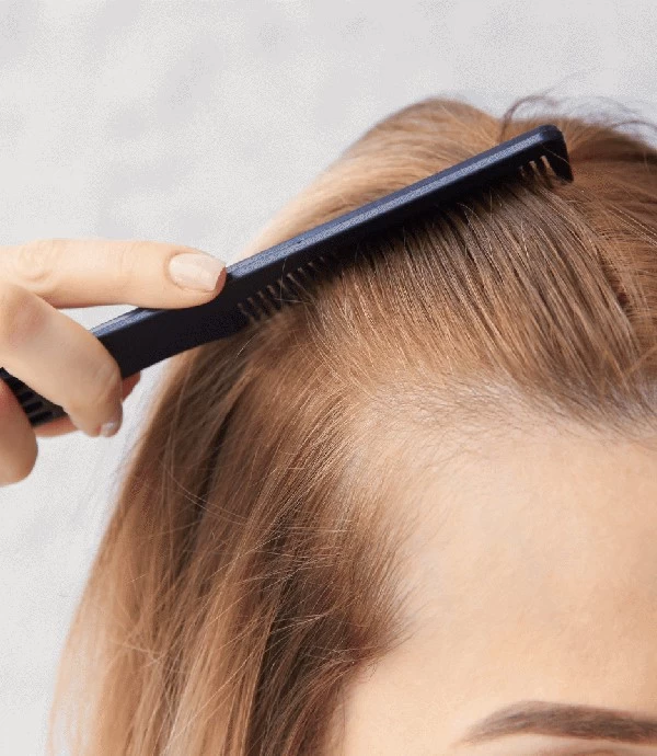 Natürlicher Look durch Haartransplantation: Die besten Techniken für Frauen