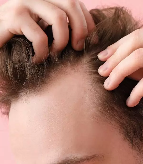 FUE Haartransplantation