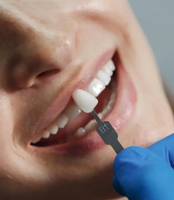Veneer / E-max